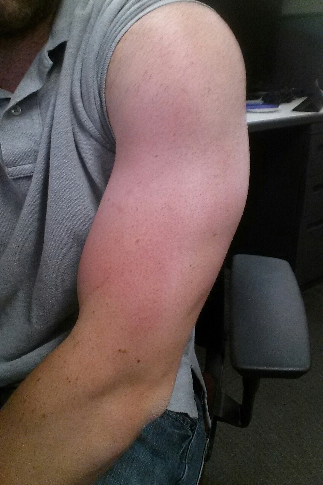 Doctor insights on: Red Rash On Arm Hot To Touch - HealthTap