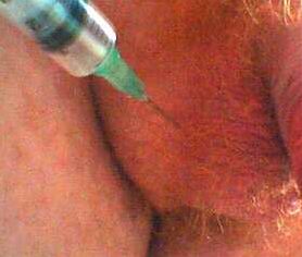 Anabolic steroids injection spots