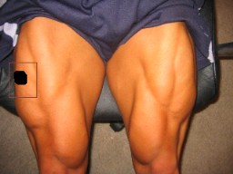 Steroid injection quadriceps