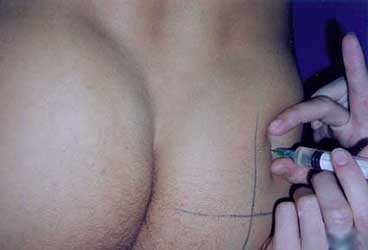 Injection sites for steroids thigh