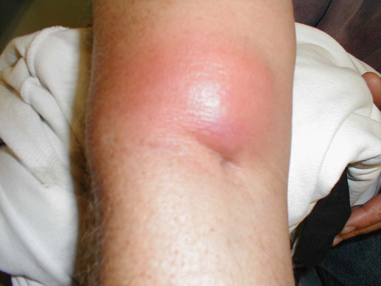 Recurrent Cellulitis: Robust Information From an RCT