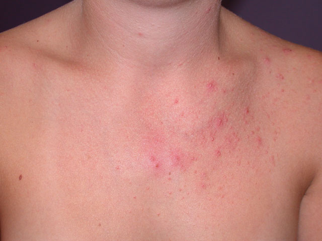 Folliculitis Treatments and drugs - Mayo Clinic