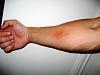 Click image for larger version. 

Name:	forearmtear.jpg 
Views:	732 
Size:	24.0 KB 
ID:	114889