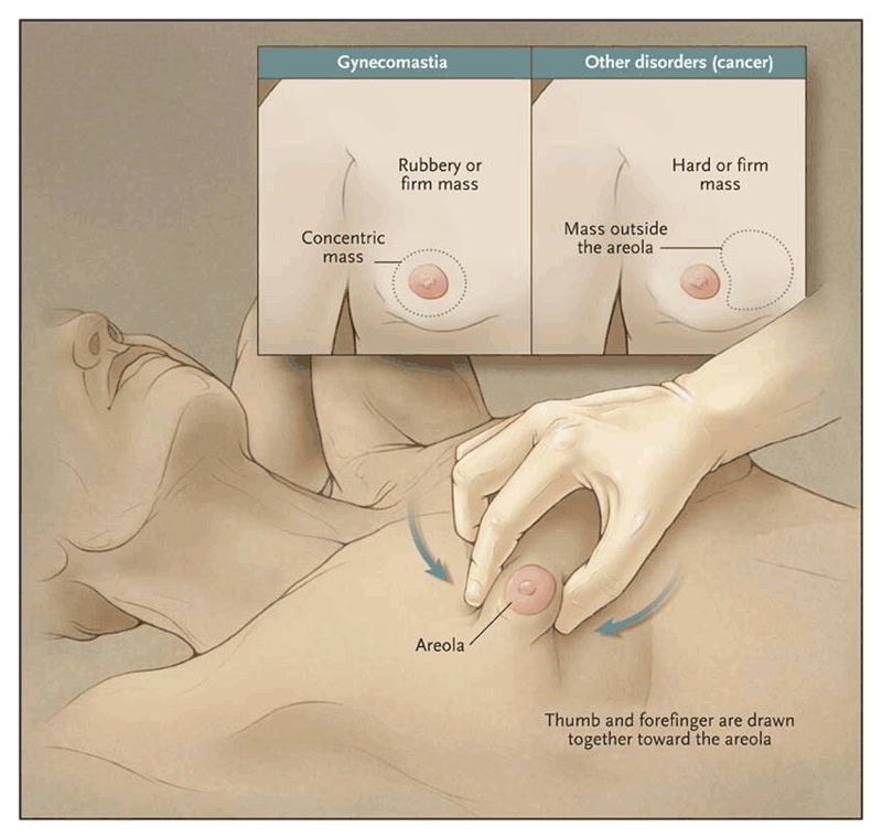 Click image for larger version. 

Name:	GYNO-NEJM-2.gif 
Views:	5925 
Size:	179.6 KB 
ID:	127500
