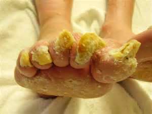 Click image for larger version. 

Name:	toenail fungus.jpg 
Views:	201 
Size:	7.1 KB 
ID:	133508