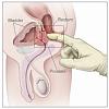 Click image for larger version. 

Name:	Enlarged-Prostate-Symptom.jpg 
Views:	586 
Size:	10.6 KB 
ID:	145371