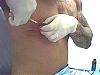 Click image for larger version. 

Name:	20127d1056661115-pics-my-do-yerself-gyno-surgery-during.jpg 
Views:	11127 
Size:	51.6 KB 
ID:	150391