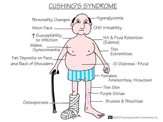 Click image for larger version. 

Name:	cushings-syndrome-1450AD2EAF11219A1B5.jpg 
Views:	1530 
Size:	33.7 KB 
ID:	171113