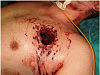Click image for larger version. 

Name:	Large-thoracic-wound-due-to-a-shotgun.png 
Views:	96 
Size:	115.2 KB 
ID:	179171