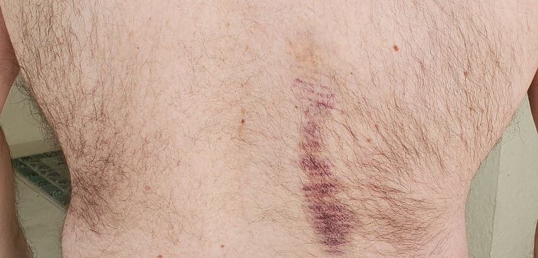 Click image for larger version. 

Name:	CylonBackBruise.jpg 
Views:	55 
Size:	121.4 KB 
ID:	181077