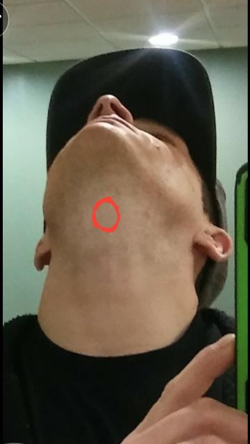 Wierd Hard Pea Sized Lump Under Chin Were Thyroid Is