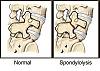 Spondylolysis-spondy.jpg