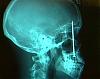 Man survives 4 inch nail in head for 6 days-050117_nail_head_hmed7a.h2.jpg