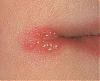 Who wants to KISS me?????-oral_herpes_simplex_prim_19.jpg