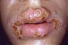 Who wants to KISS me?????-oral_herpes_simplex_prim_20.jpg