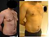 My Gyno surgery (before and after pics)-1.jpg