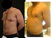 My Gyno surgery (before and after pics)-2.jpg