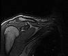 Still can't diagnose shoulder problem/any advice?-mri-scan.jpg