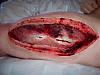 Friend w/ Compartment Syndrome... (Graphic Photos inside)-compartment-syndrome.jpg