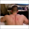 What happens when muscle is missed during injection??-pete-back.jpg