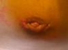 Nipple pic after gyno surgery-2.19.10-092_edited.jpg