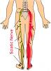 Lower Back Pain, could it be from my injection?-sciaticnervetreatment.jpg