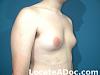 GYNO...how bad can it get?-gynecomastia-male-breast-reduction-before-fullsize-30554-60352.jpg