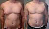 GYNO...how bad can it get?-asymmetric_gynecomastia.jpg