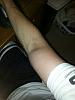 swelling inner arm, to above elbow after delt injection-forumrunner_20140828_162442.jpg