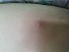 Red painful spot between thighs.-forumrunner_20150824_180222.jpg