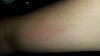 Bruised bicep vein after delt injection?-20170706_164924.jpg