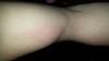 Bruised bicep vein after delt injection?-20170706_173030.jpg