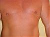 Gyno Surgery and the aftermath-mvc-034s.jpg
