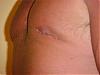 Gyno Surgery and the aftermath-mvc-036s.jpg