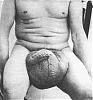 step by step guide to a proper testicular injection!-elephantiasis.jpg