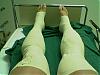 You think its just calf strain but you are probably wrong - Compartment Syndrome-image-056-.jpg