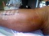 You think its just calf strain but you are probably wrong - Compartment Syndrome-image-059-.jpg