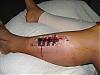 You think its just calf strain but you are probably wrong - Compartment Syndrome-img_2281.jpg