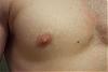 Calling All Experts ! - Possible Gyno? Help Me Figure Out If It Is Or Not! Ahhh-right2.jpg