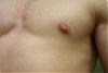 Calling All Experts ! - Possible Gyno? Help Me Figure Out If It Is Or Not! Ahhh-left4.jpg