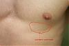 Calling All Experts ! - Possible Gyno? Help Me Figure Out If It Is Or Not! Ahhh-left2.jpg