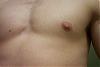 Calling All Experts ! - Possible Gyno? Help Me Figure Out If It Is Or Not! Ahhh-left3.jpg