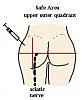 glute injections-safe.gif