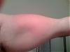 infection or irritation?-bicep-2-resized.jpg