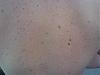 Moles or Freckles on back???-downsized_0915082233-2.jpg