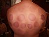 Old guy making a comeback...-cupping-800x600-.jpg