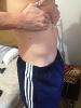 Bulking for loose skin.-image-3945976858.jpg