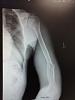 Surgery from spiral fracture, with Plate/Hardware screwed, to Humerus-10440240_240299819498607_9094512897633071832_n.jpg