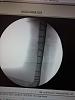 Surgery from spiral fracture, with Plate/Hardware screwed, to Humerus-10494847_244546182407304_8732290745011755546_n.jpg