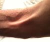 Bicep tendon rupture-1-op-day-3may2011.jpg